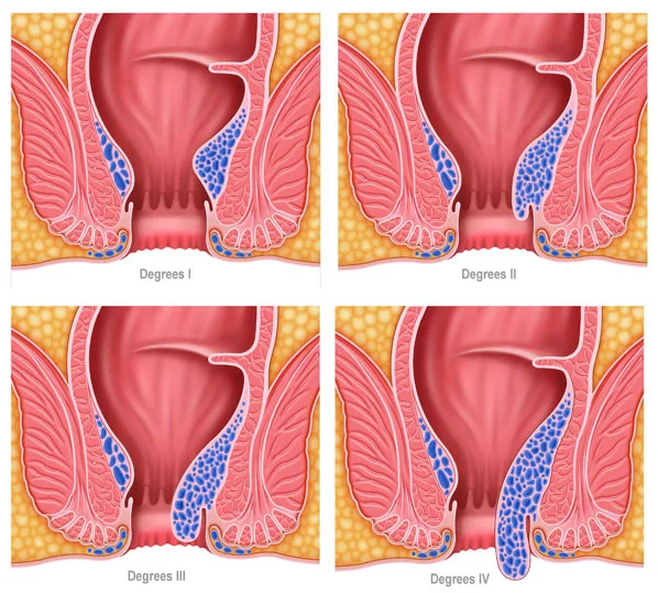Anatomy illustration of internal and external hemorrhoids