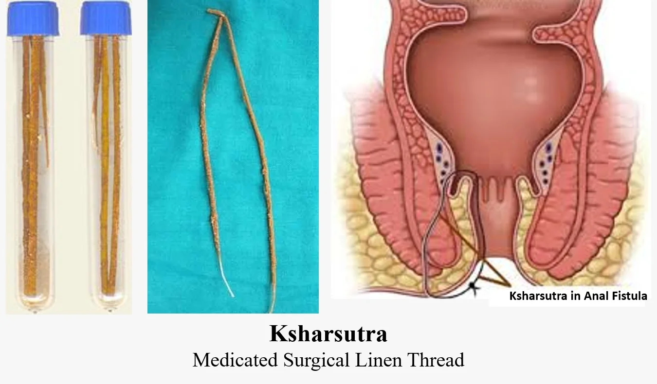Ksharasutra — Medicated Surgical Linen Thread